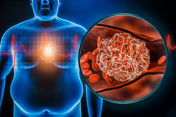 How Does Obesity Affect the Heart?