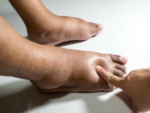 How Do You Know If Swollen Feet Are Heart-Related