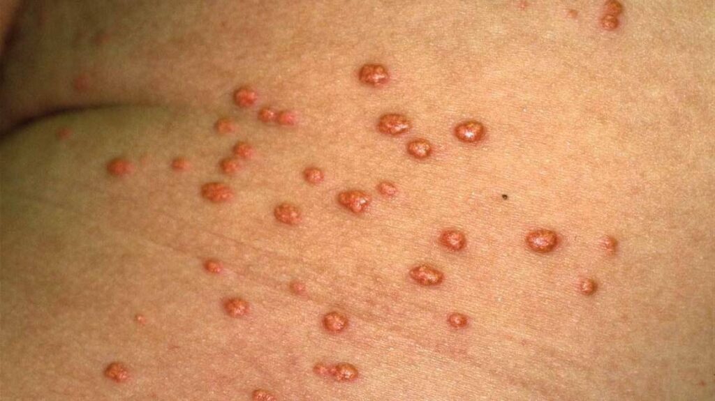 Does Heart Failure Cause Itching?