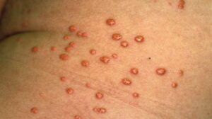 Does Heart Failure Cause Itching?