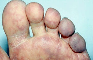 Understanding Skin Changes in Heart Failure